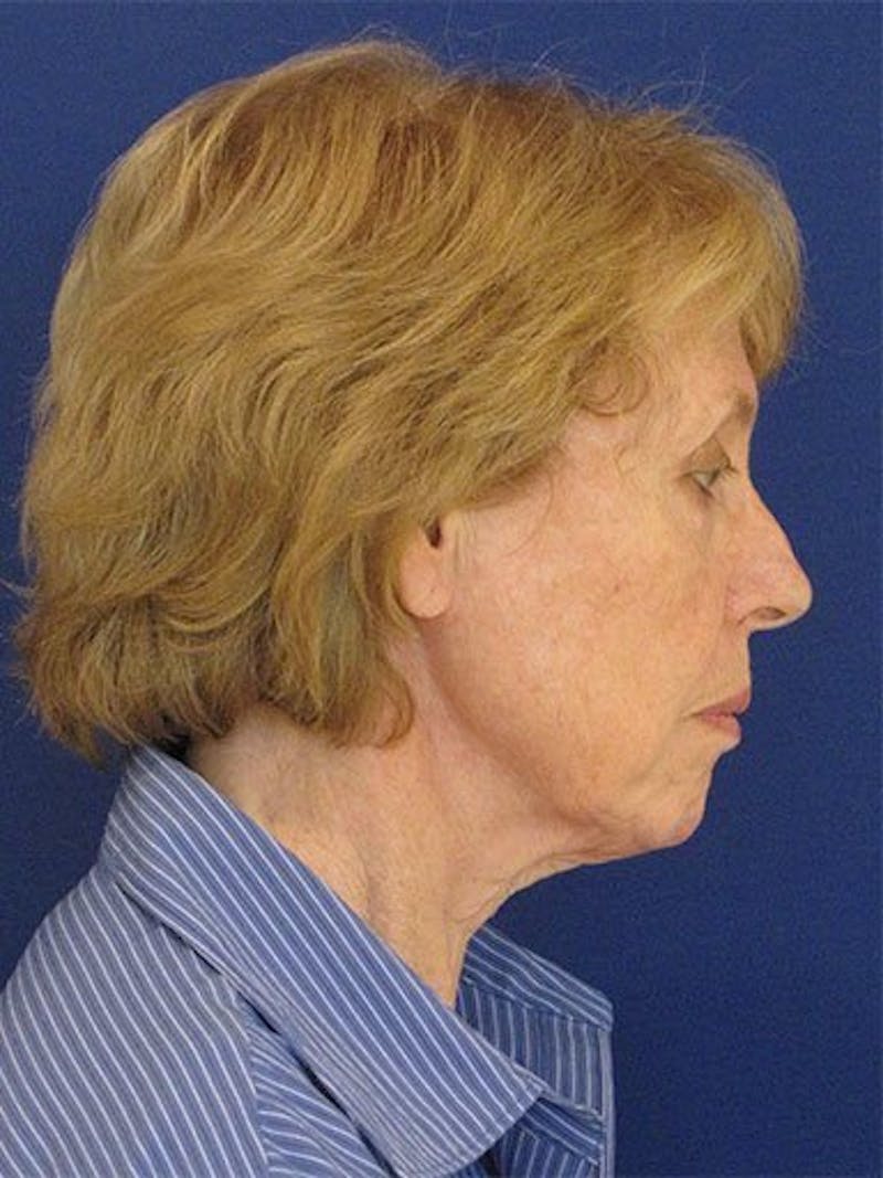 Facelift Before & After Gallery - Patient 17331361 - Image 3