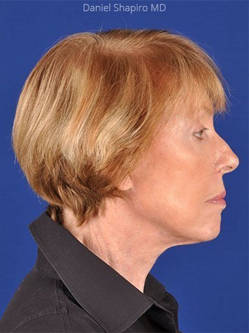 Facelift Before & After Gallery - Patient 17331361 - Image 4