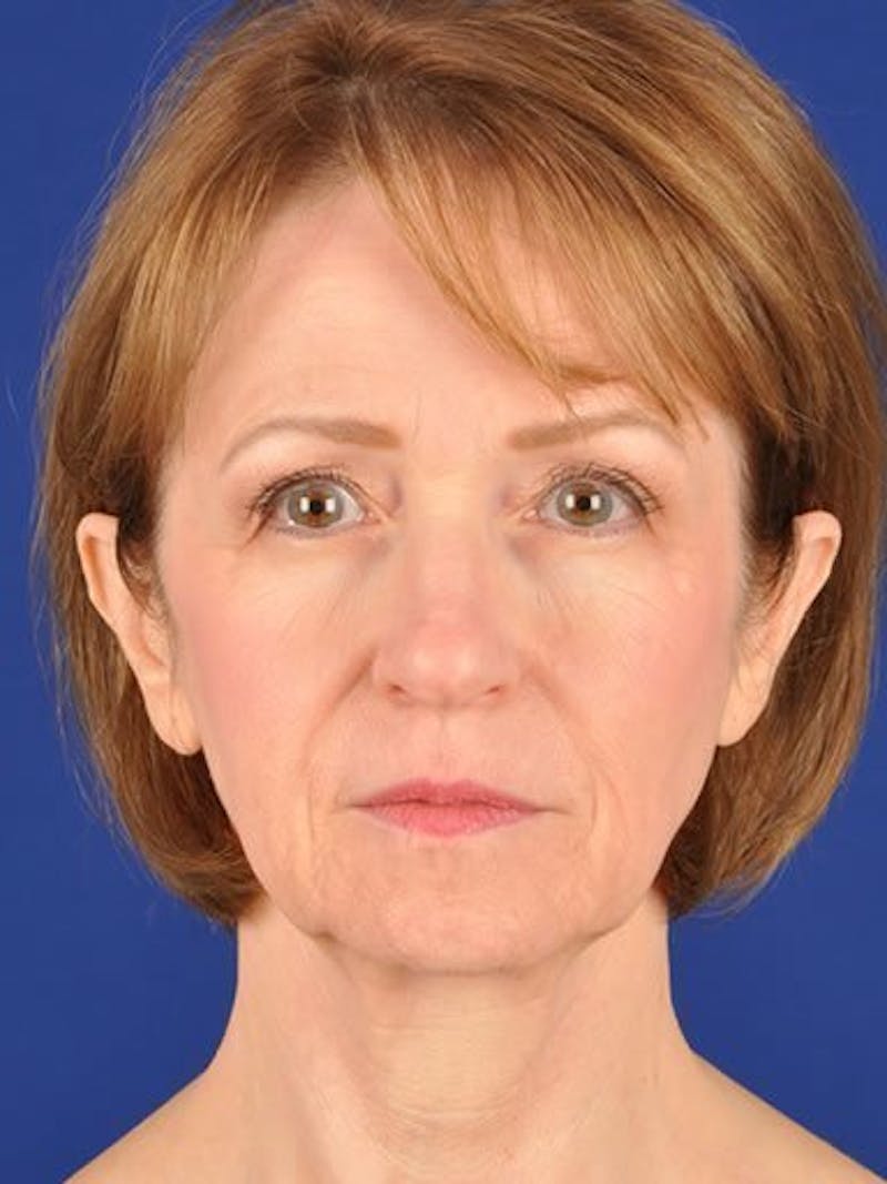 Facelift Before & After Gallery - Patient 17331367 - Image 1
