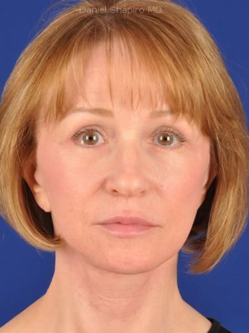 Facelift Before & After Gallery - Patient 17331367 - Image 2