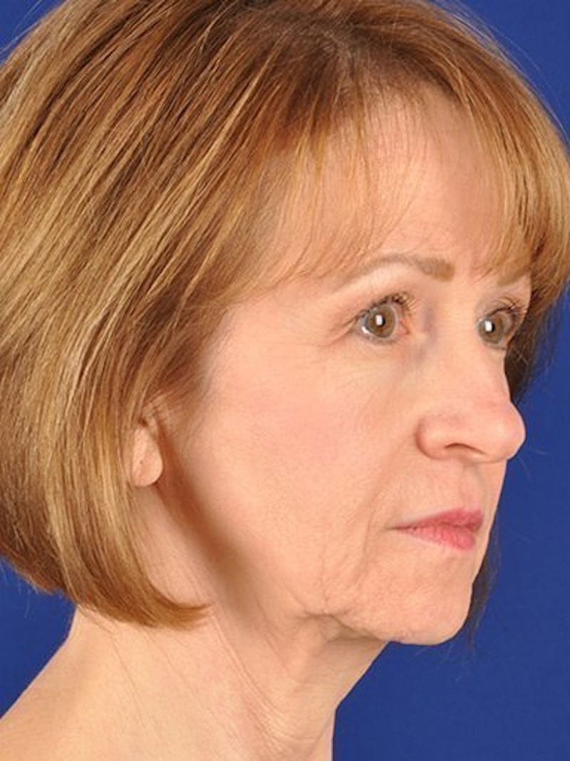 Facelift Before & After Gallery - Patient 17331367 - Image 3