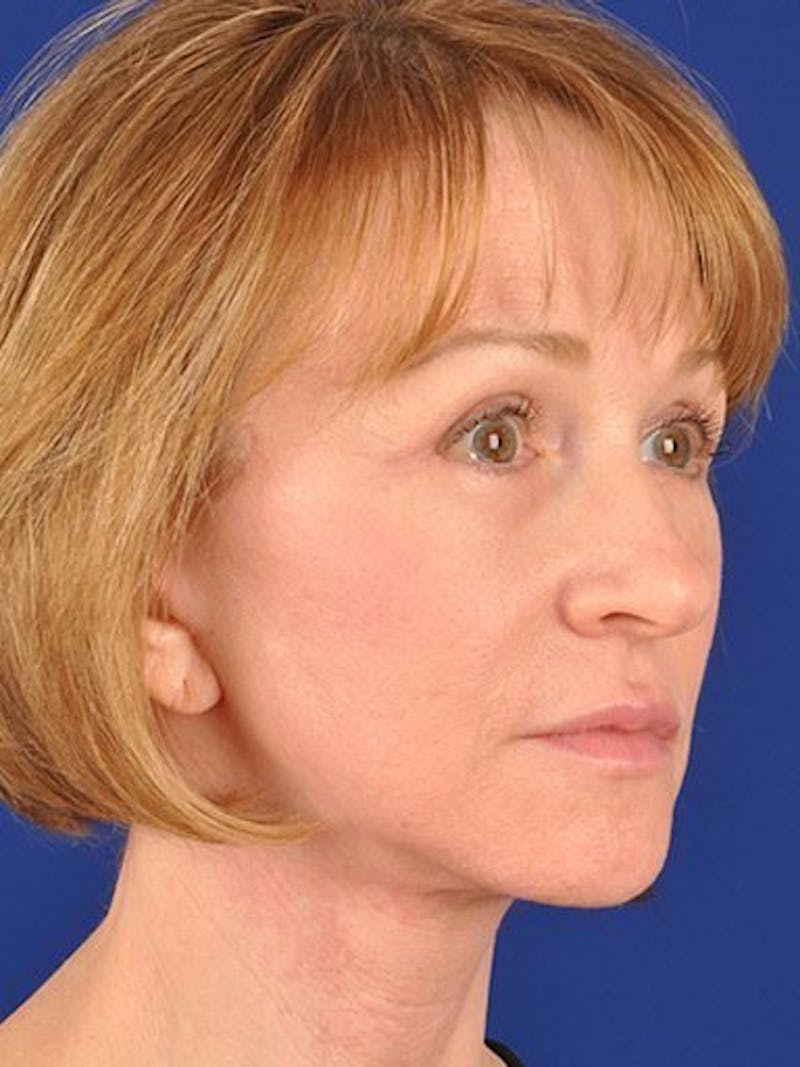 Facelift Before & After Gallery - Patient 17331367 - Image 4