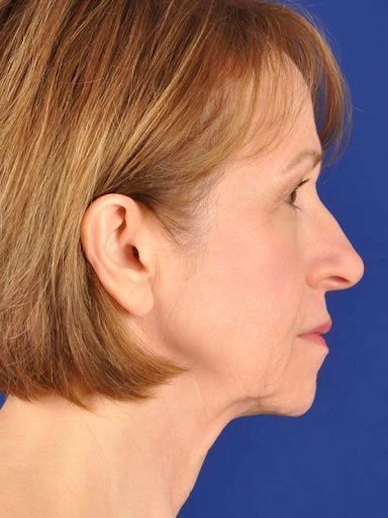 Facelift Before & After Gallery - Patient 17331367 - Image 5