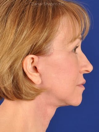 Facelift Before & After Gallery - Patient 17331367 - Image 6
