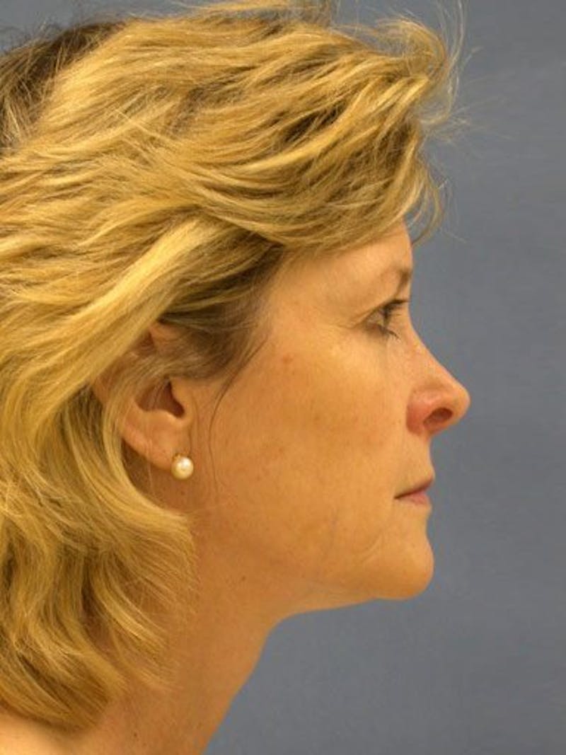 Facelift Before & After Gallery - Patient 17331368 - Image 3