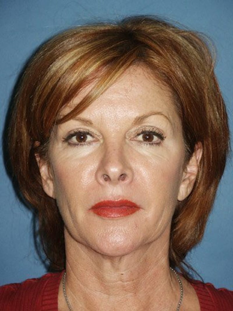 Facelift Before & After Gallery - Patient 17331369 - Image 1