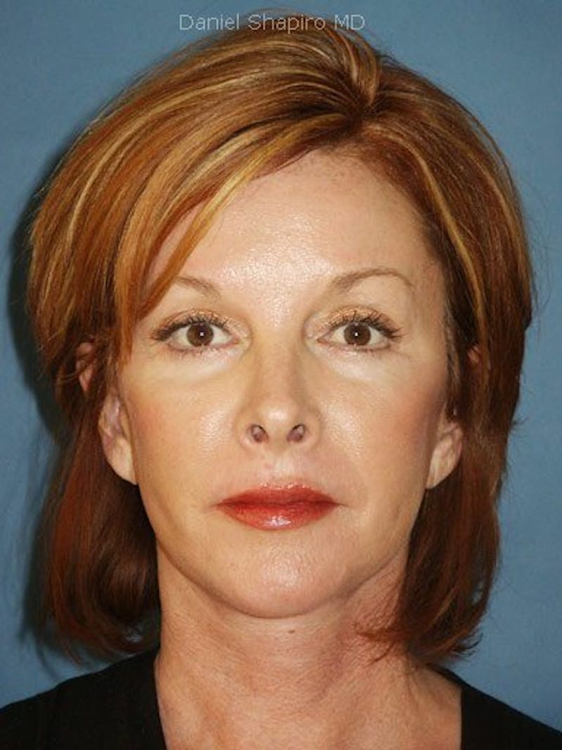 Facelift Before & After Gallery - Patient 17331369 - Image 2