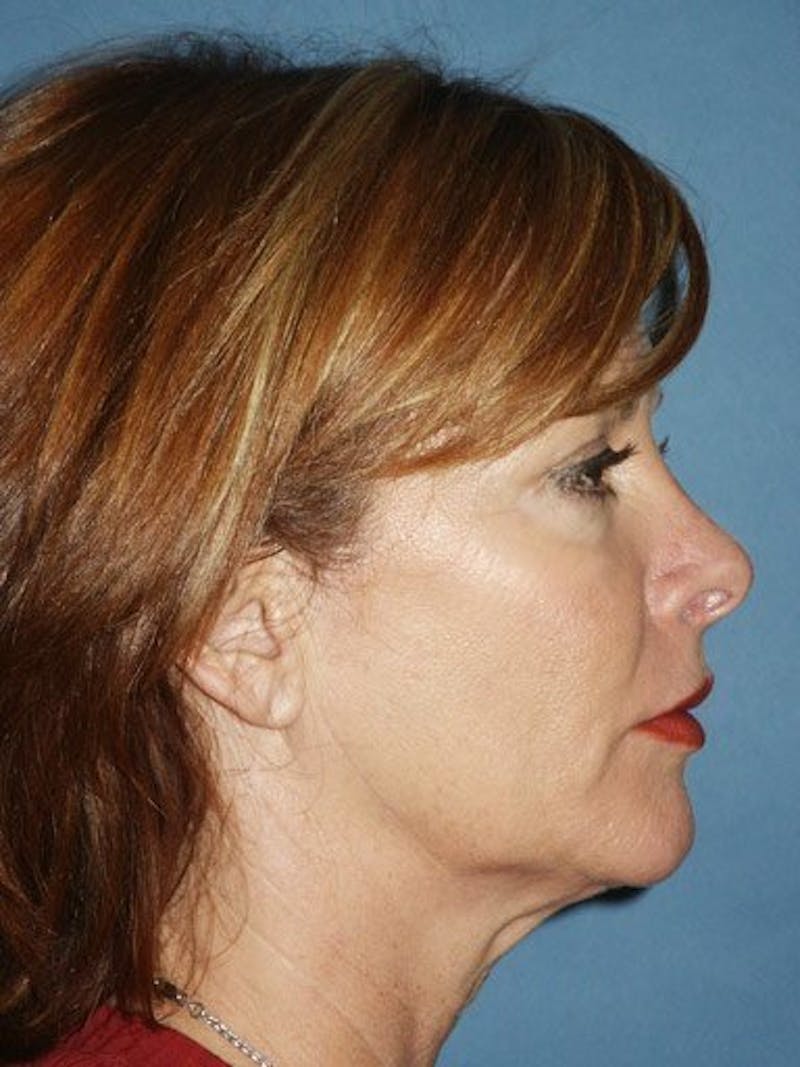 Facelift Before & After Gallery - Patient 17331369 - Image 3