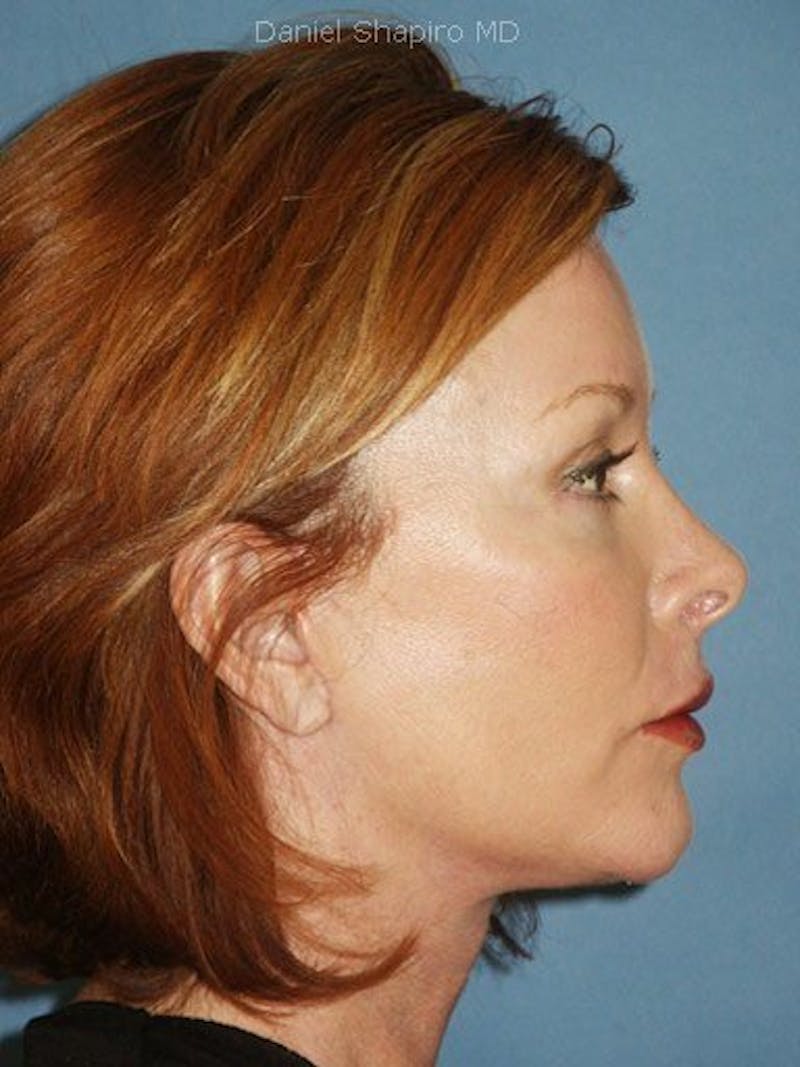 Facelift Before & After Gallery - Patient 17331369 - Image 4