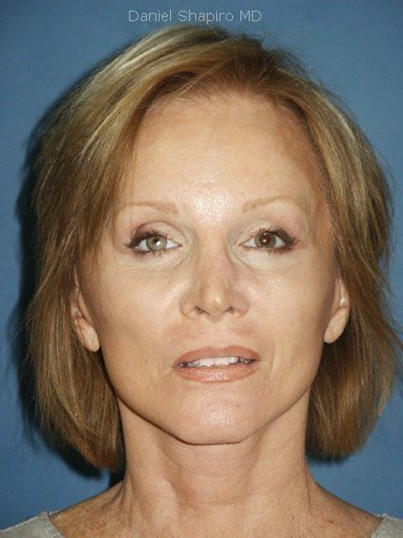 Facelift Before & After Gallery - Patient 17331373 - Image 2