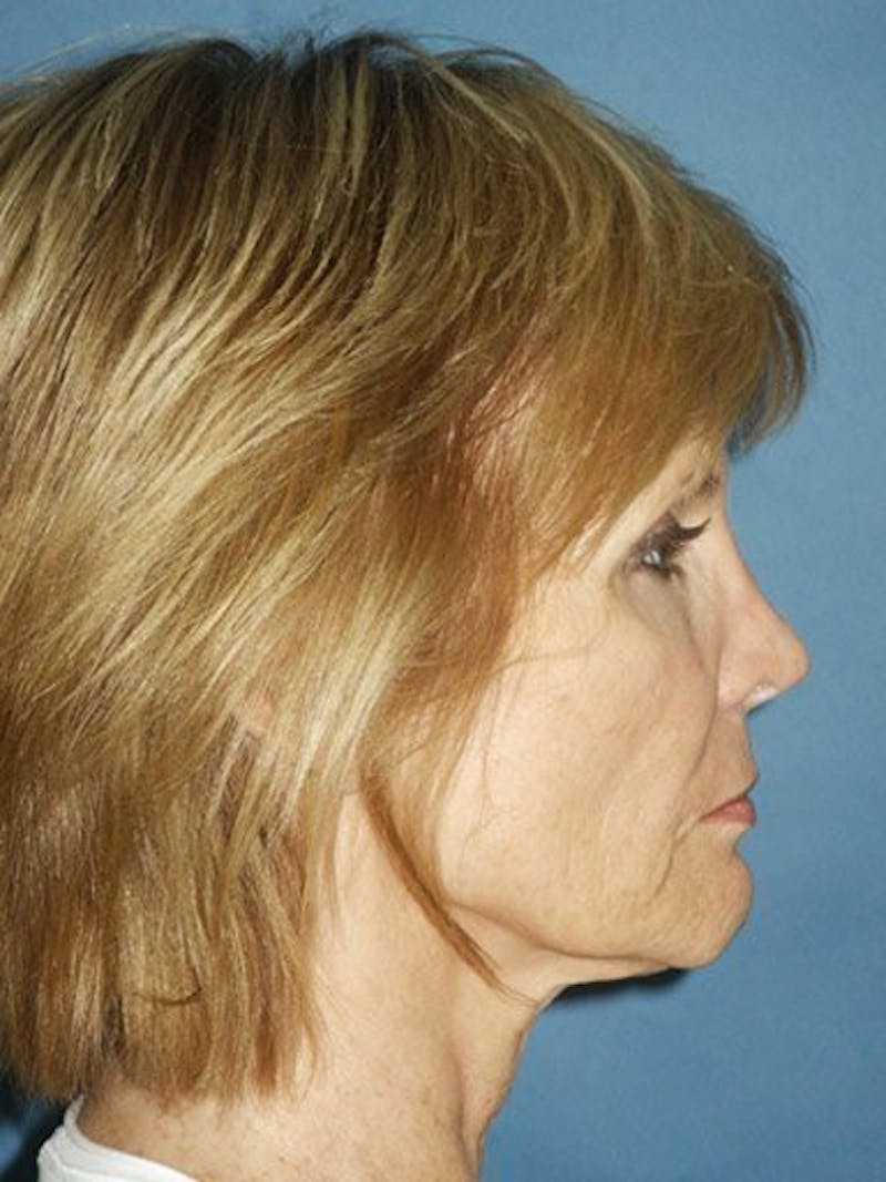 Facelift Before & After Gallery - Patient 17331373 - Image 3