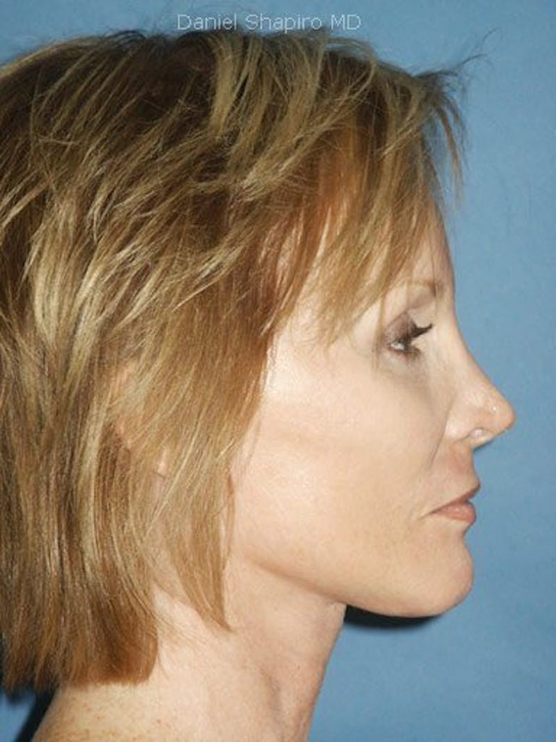 Facelift Before & After Gallery - Patient 17331373 - Image 4