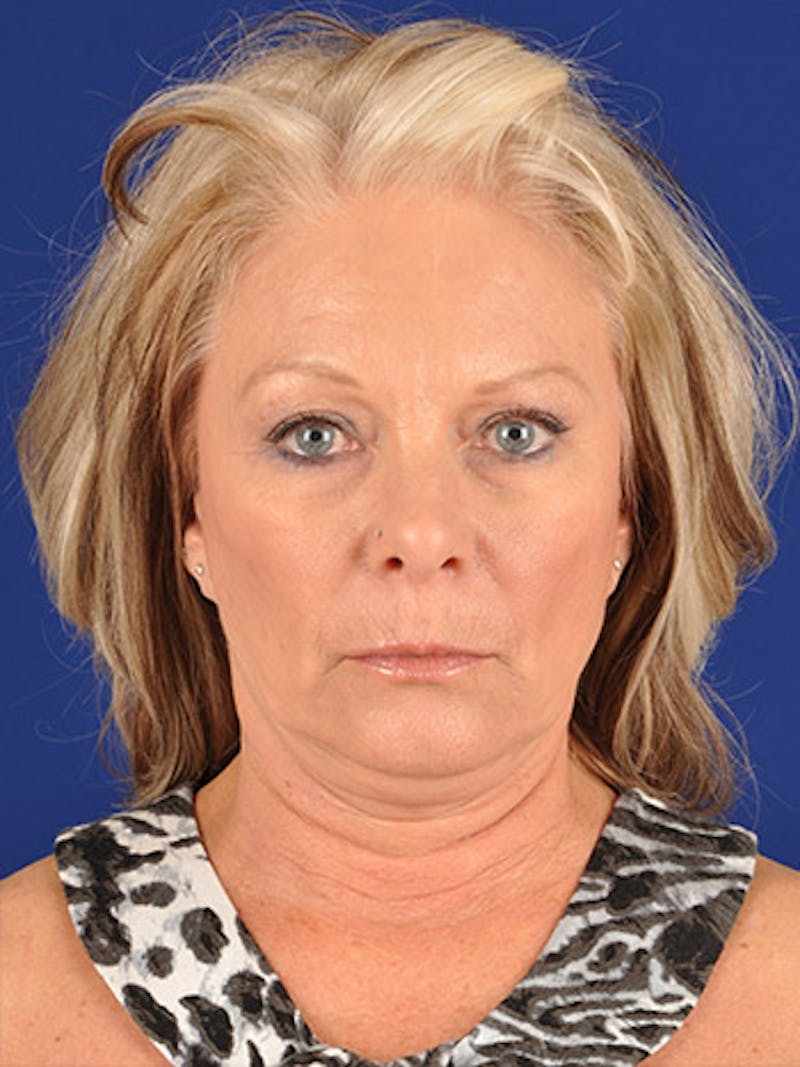 Facelift Before & After Gallery - Patient 17331374 - Image 1