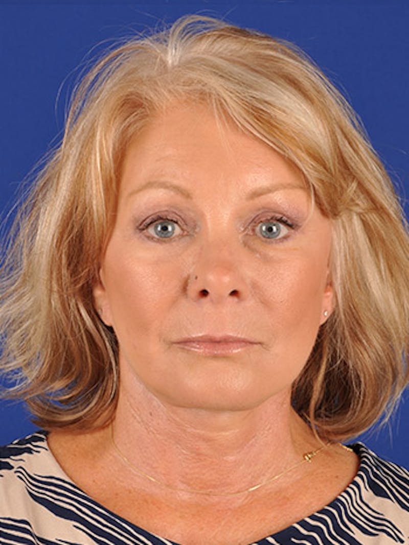 Facelift Before & After Gallery - Patient 17331374 - Image 2