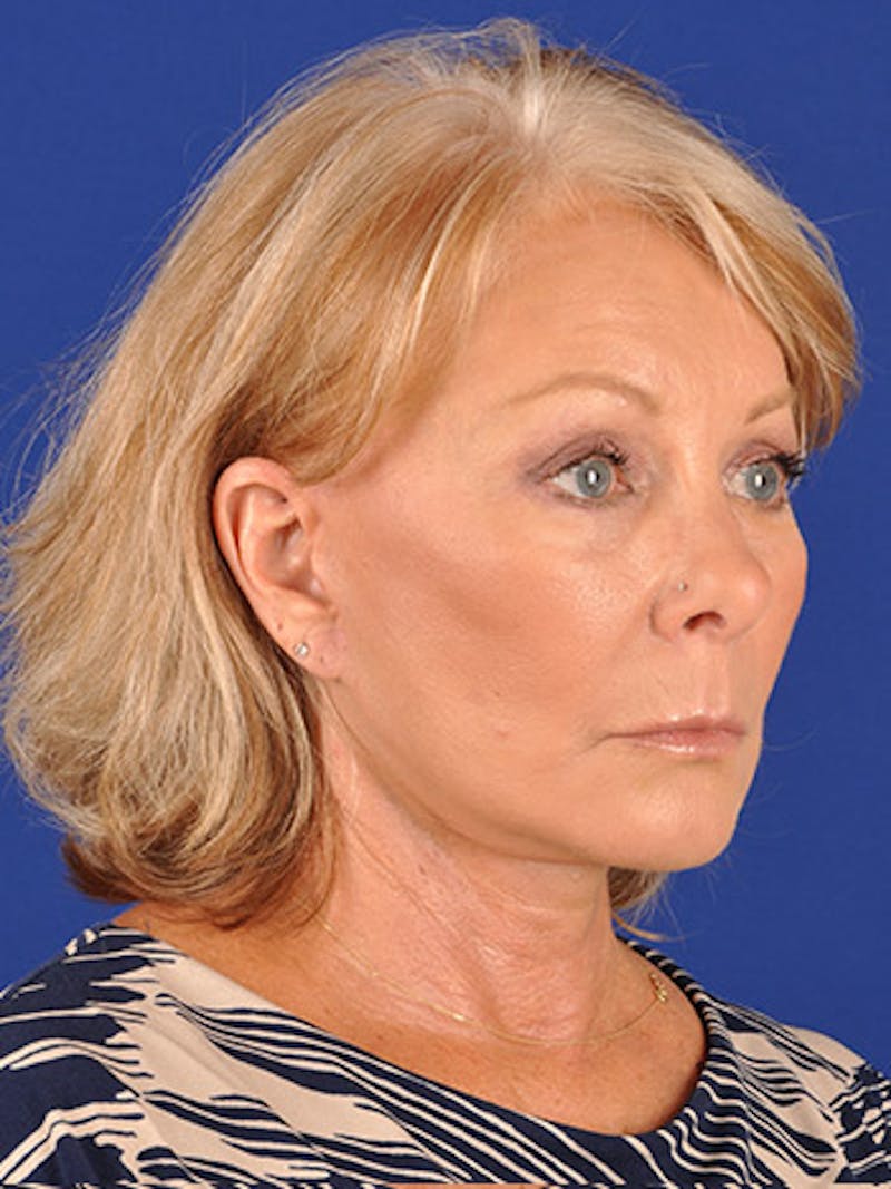 Facelift Before & After Gallery - Patient 17331374 - Image 4