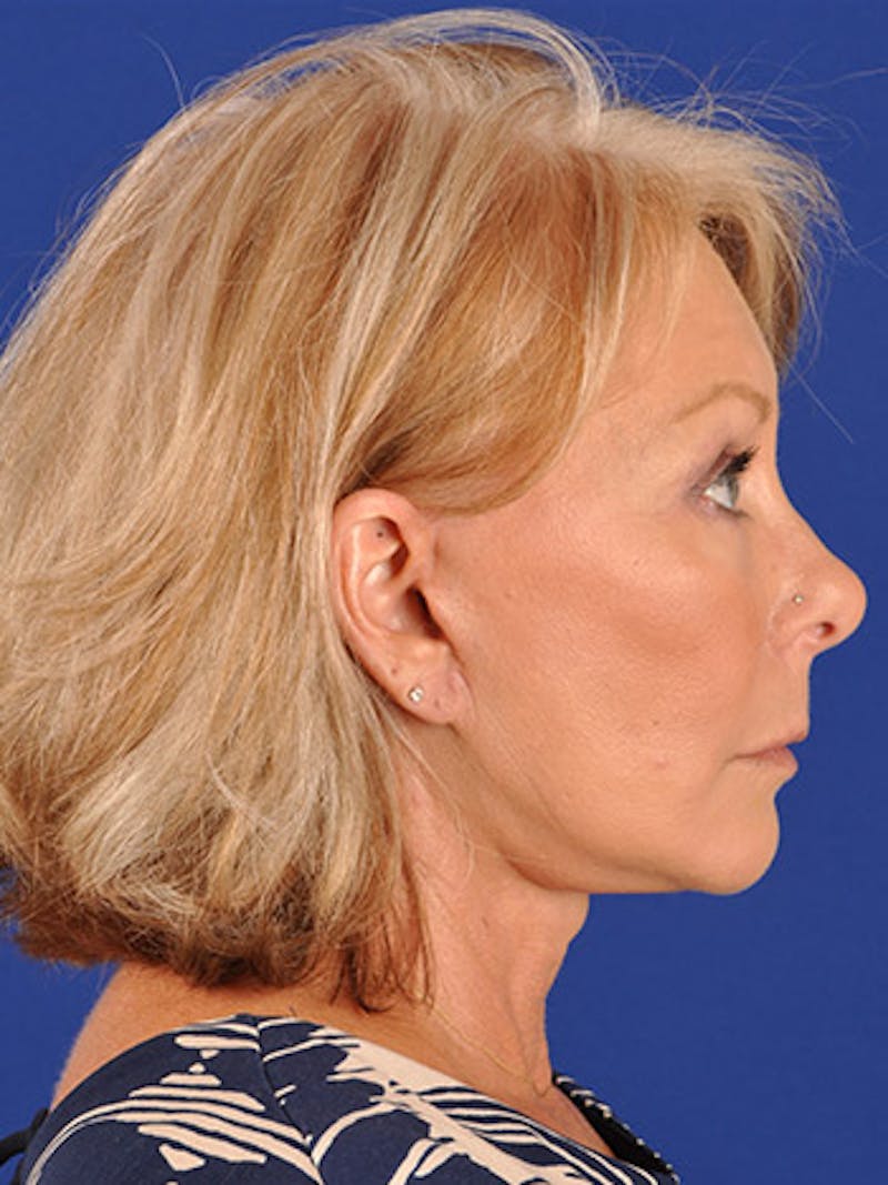 Facelift Before & After Gallery - Patient 17331374 - Image 6