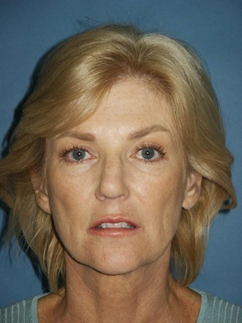 Facelift Before & After Gallery - Patient 17331377 - Image 1