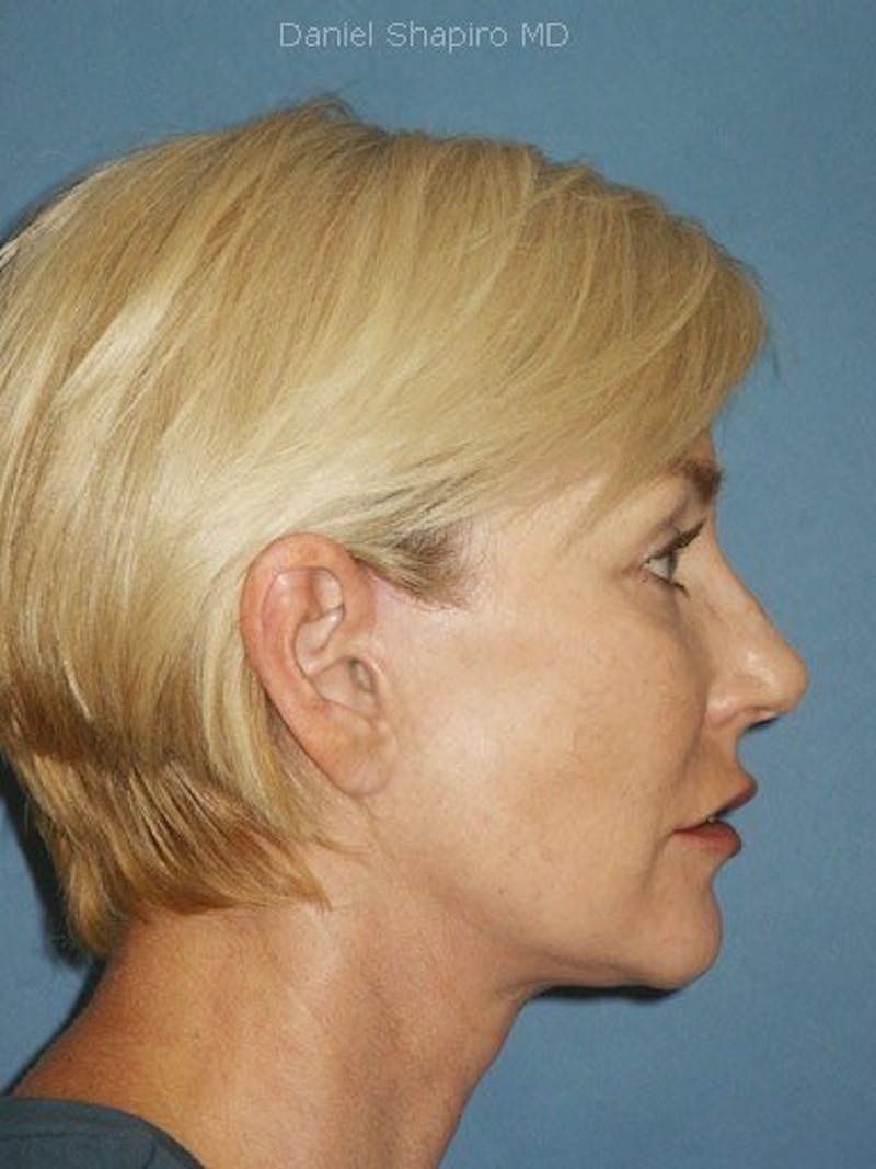 Facelift Before & After Gallery - Patient 17331377 - Image 4