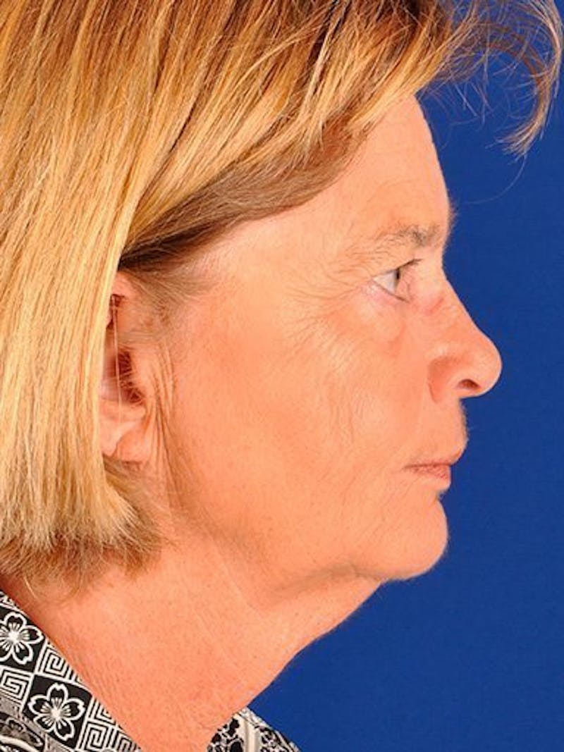 Facelift Before & After Gallery - Patient 17332936 - Image 5