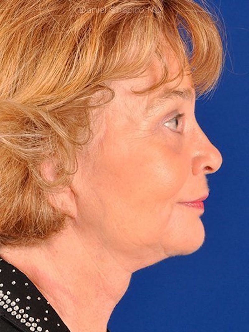 Facelift Before & After Gallery - Patient 17332936 - Image 6