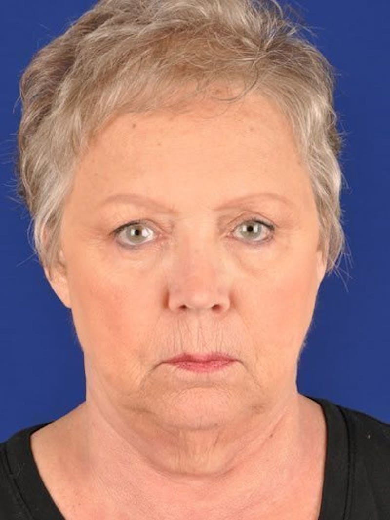 Facelift Before & After Gallery - Patient 17332938 - Image 1
