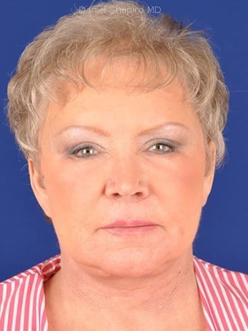 Facelift Before & After Gallery - Patient 17332938 - Image 2