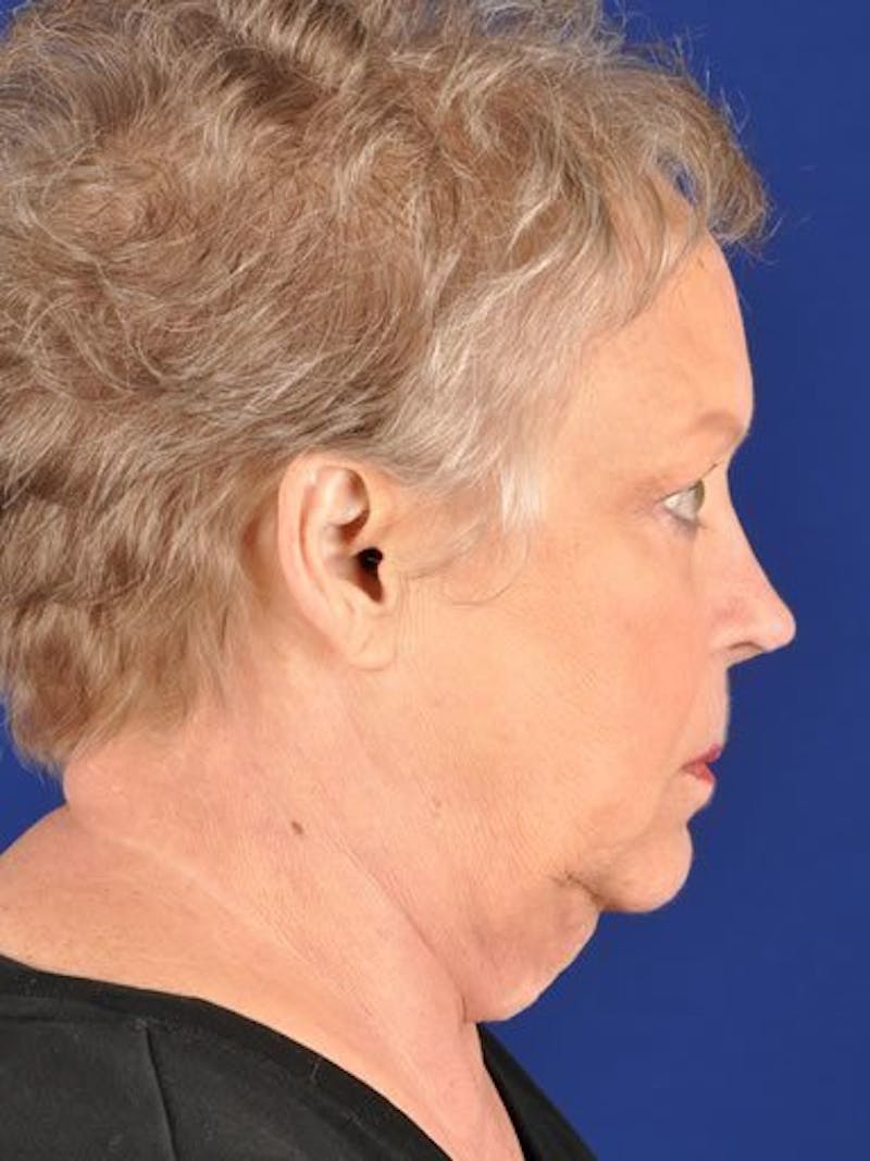 Facelift Before & After Gallery - Patient 17332938 - Image 3