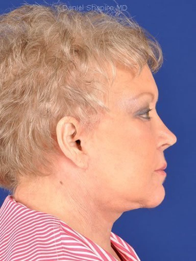 Facelift Before & After Gallery - Patient 17332938 - Image 4