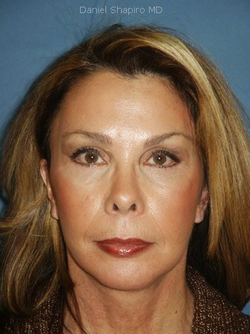 Facelift Before & After Gallery - Patient 17334503 - Image 2