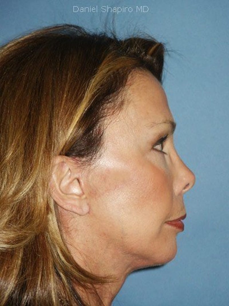Facelift Before & After Gallery - Patient 17334503 - Image 4