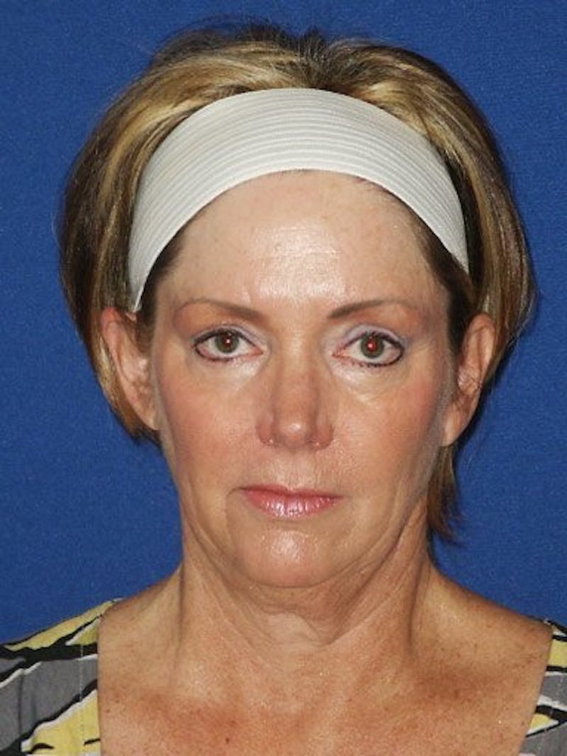 Facelift Before & After Gallery - Patient 17334506 - Image 1
