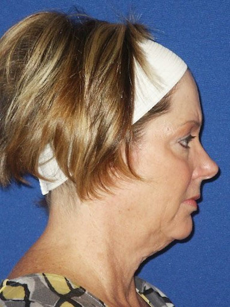 Facelift Before & After Gallery - Patient 17334506 - Image 3