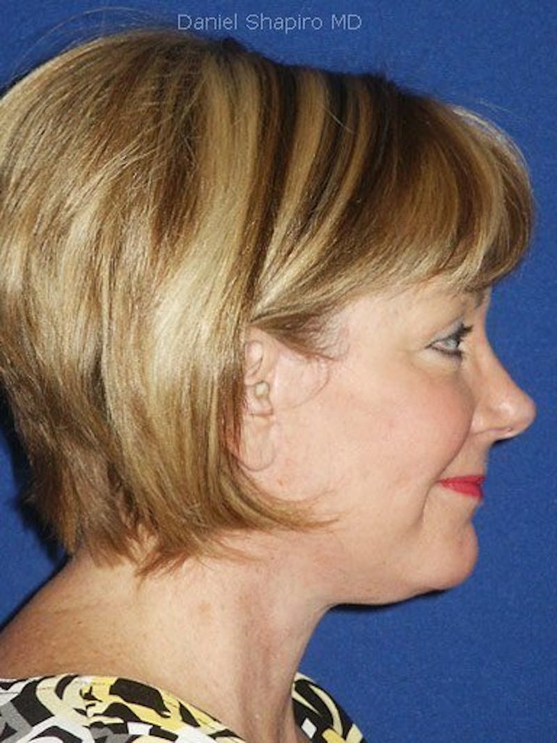 Facelift Before & After Gallery - Patient 17334506 - Image 4