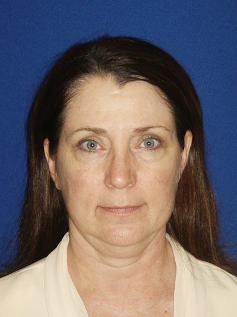 Facelift Before & After Gallery - Patient 17336065 - Image 1