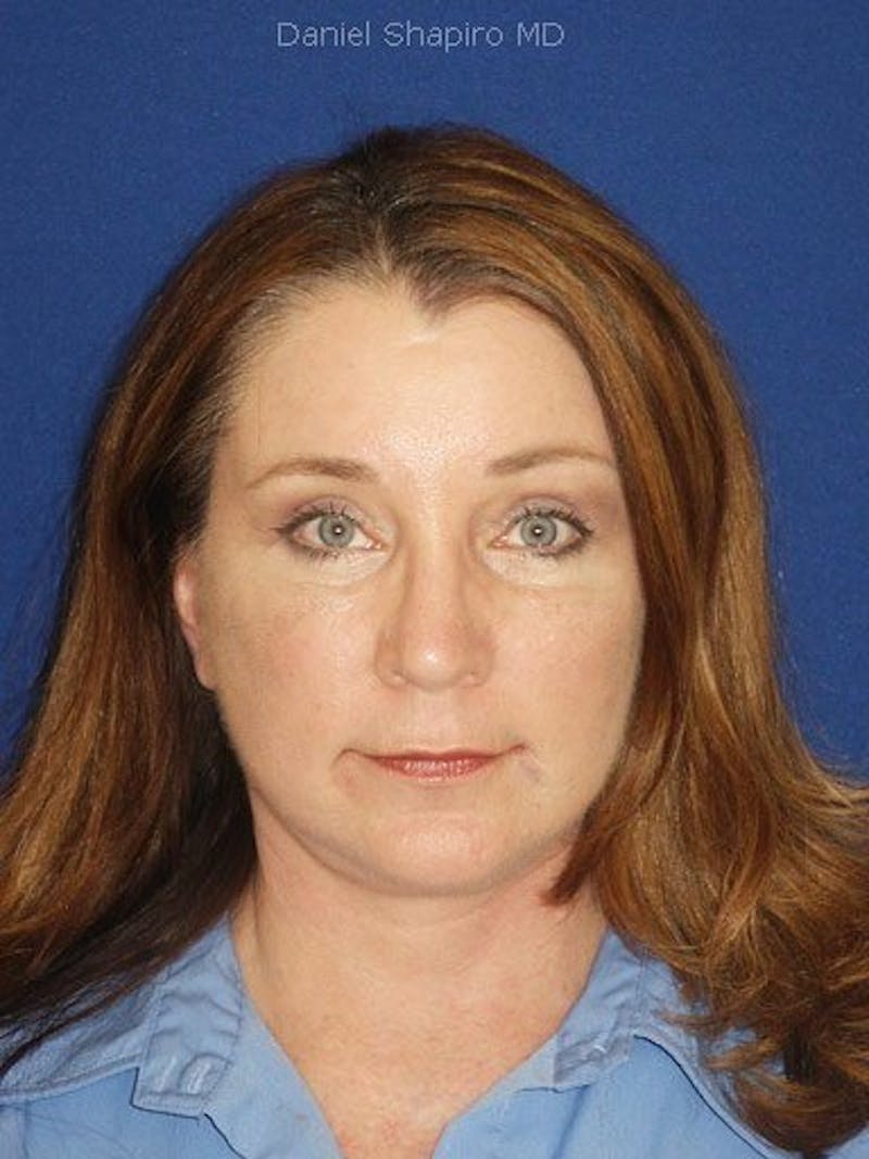 Facelift Before & After Gallery - Patient 17336065 - Image 2
