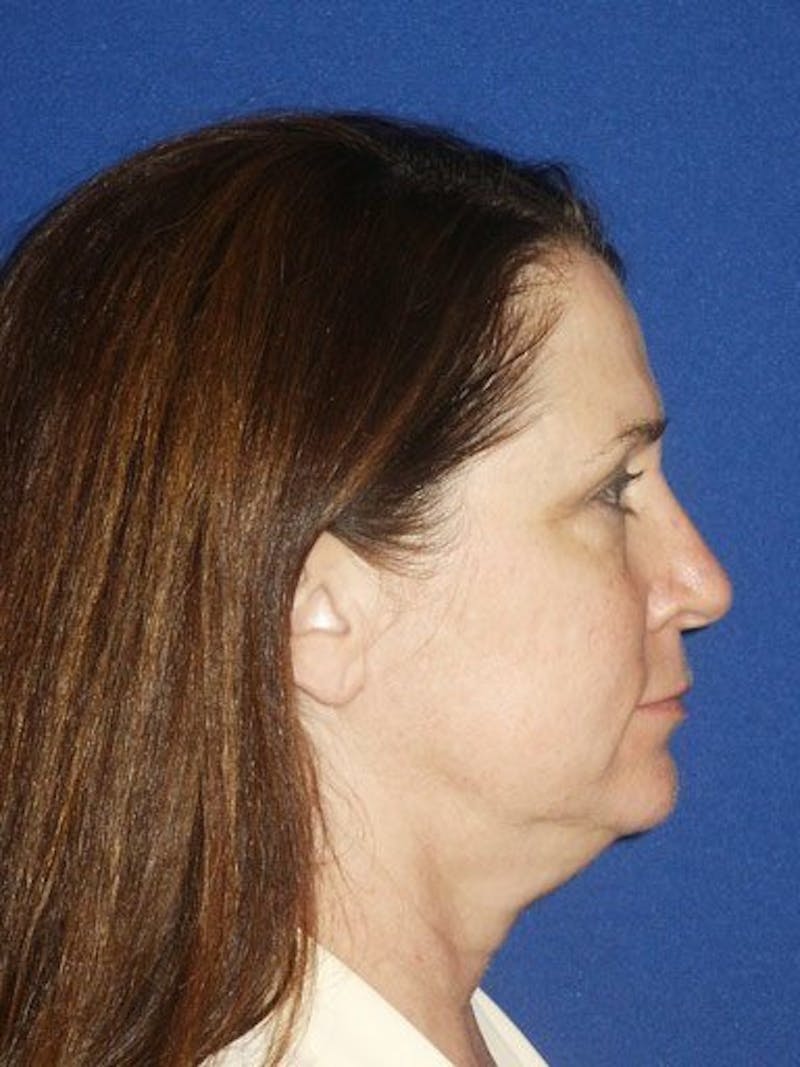 Facelift Before & After Gallery - Patient 17336065 - Image 3