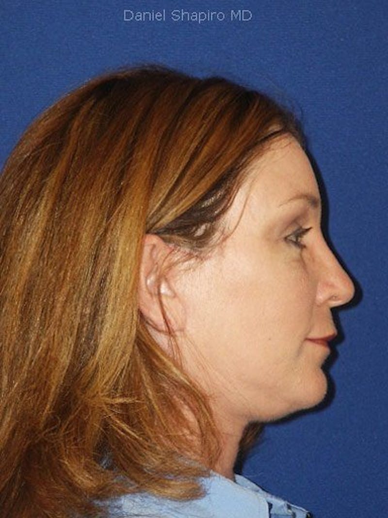 Facelift Before & After Gallery - Patient 17336065 - Image 4