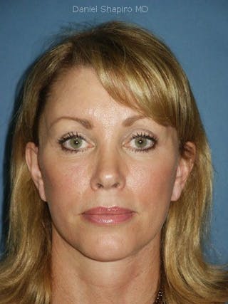 Facelift Before & After Gallery - Patient 17336067 - Image 2