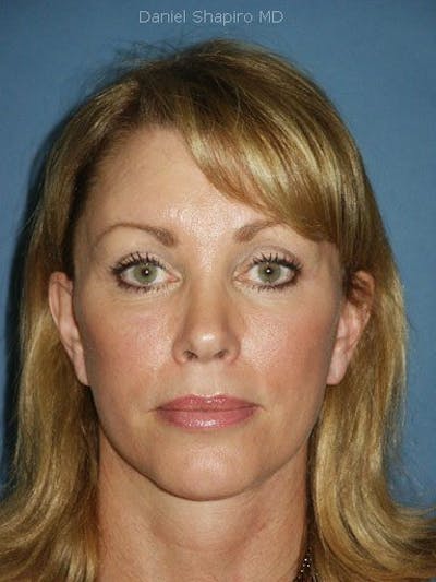 Facelift Before & After Gallery - Patient 17336067 - Image 2