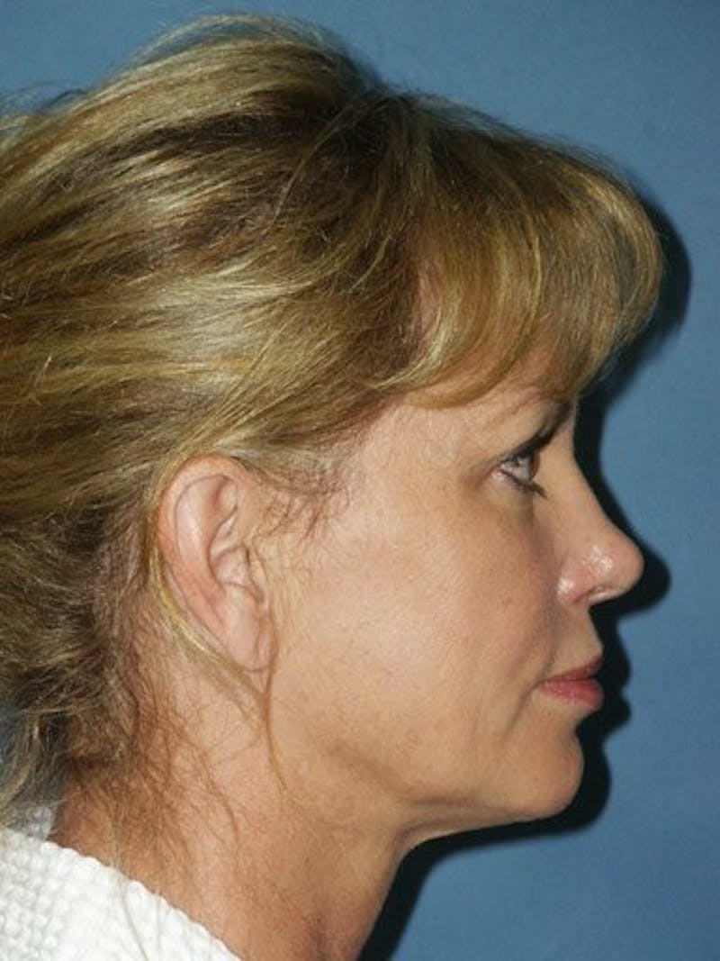 Facelift Before & After Gallery - Patient 17336067 - Image 3