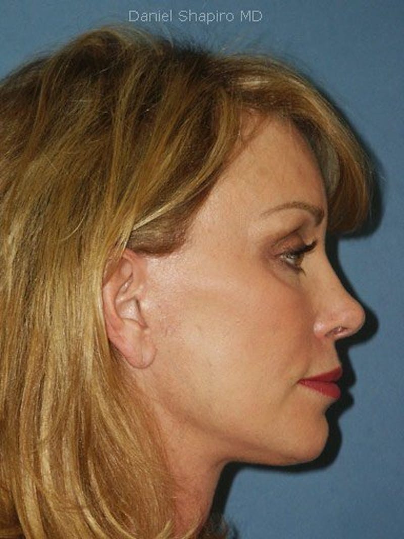Facelift Before & After Gallery - Patient 17336067 - Image 4