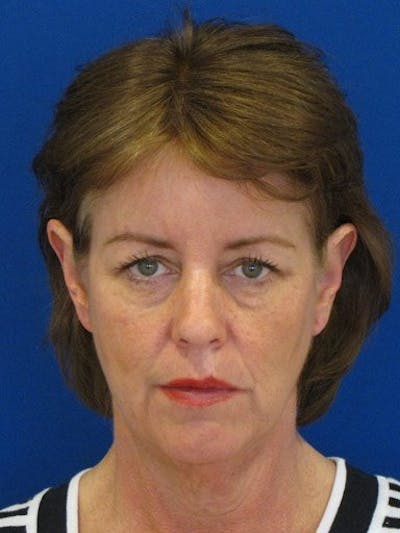 Facelift Before & After Gallery - Patient 17336070 - Image 1