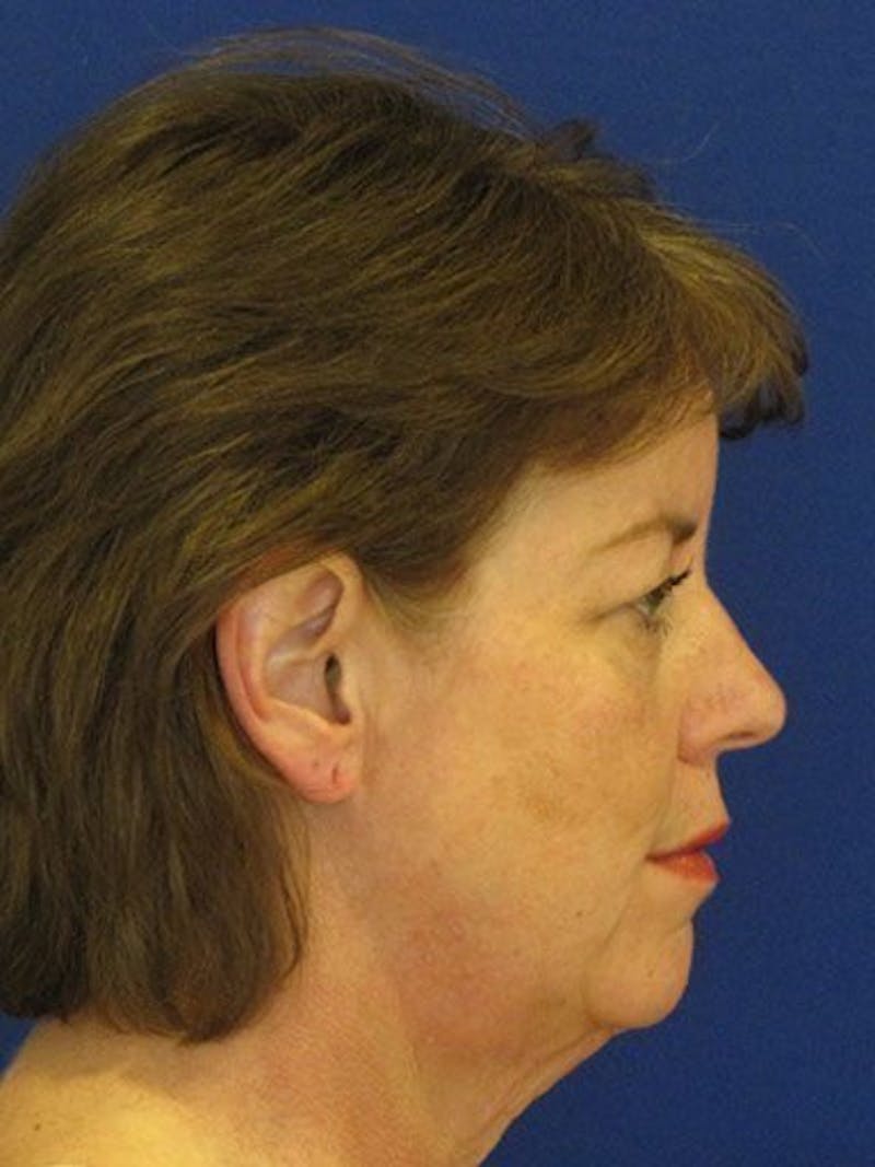 Facelift Before & After Gallery - Patient 17336070 - Image 3