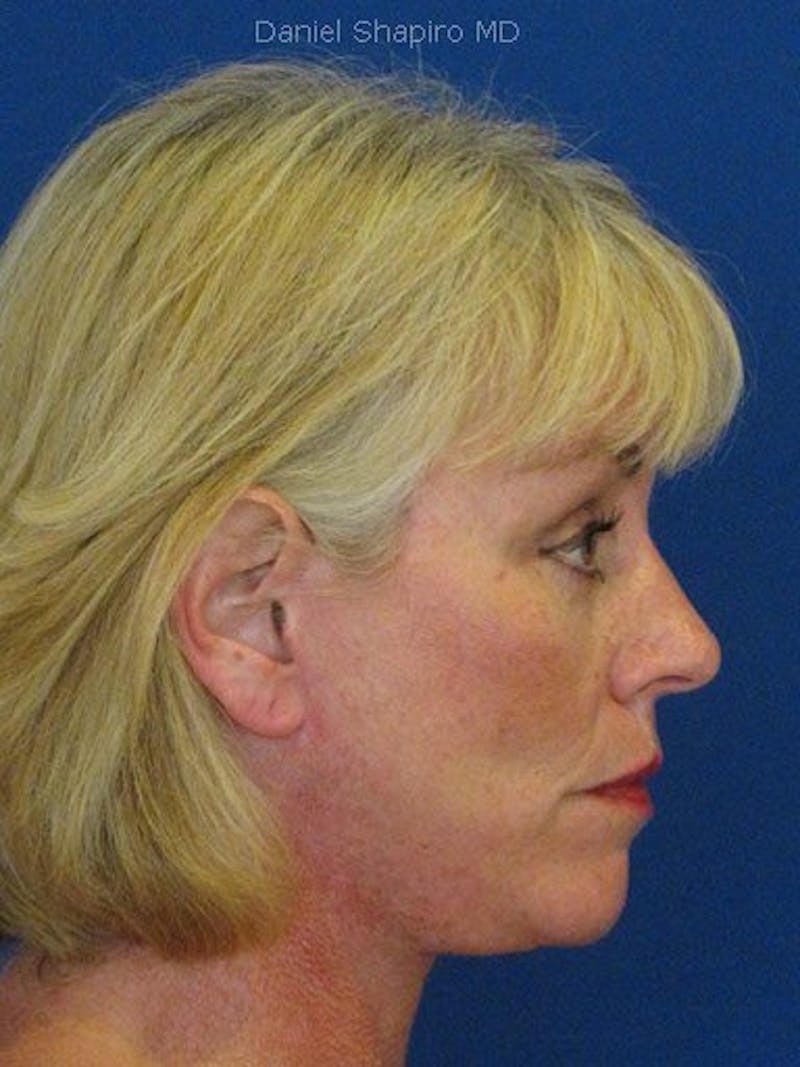 Facelift Before & After Gallery - Patient 17336070 - Image 4