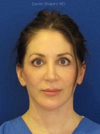 Facelift Before & After Gallery - Patient 17336074 - Image 2