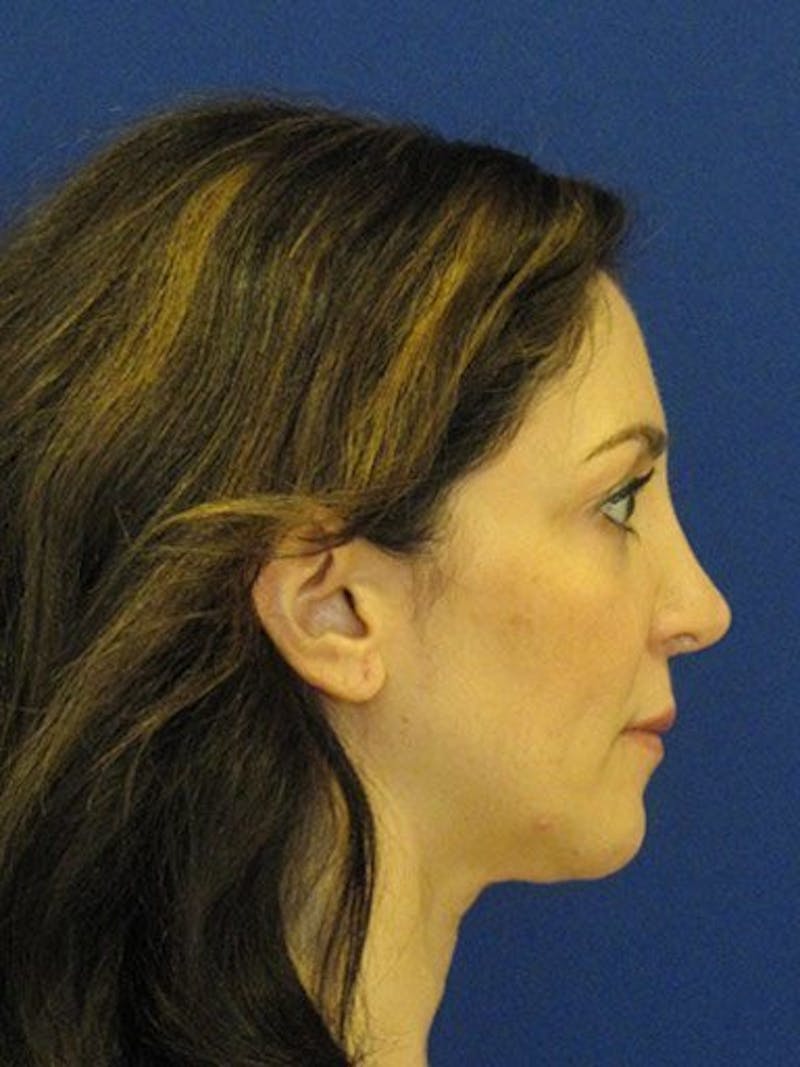 Facelift Before & After Gallery - Patient 17336074 - Image 3
