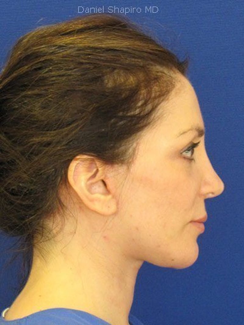 Facelift Before & After Gallery - Patient 17336074 - Image 4