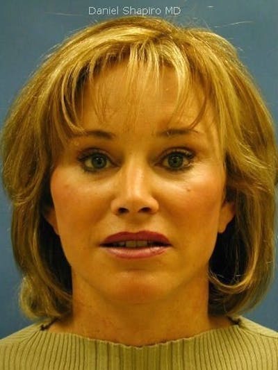 Facelift Before & After Gallery - Patient 17337635 - Image 2