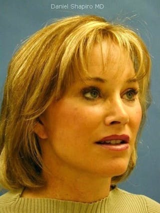 Facelift Before & After Gallery - Patient 17337635 - Image 4