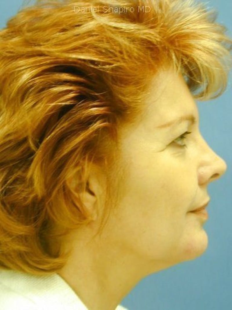 Facelift Before & After Gallery - Patient 17337637 - Image 3